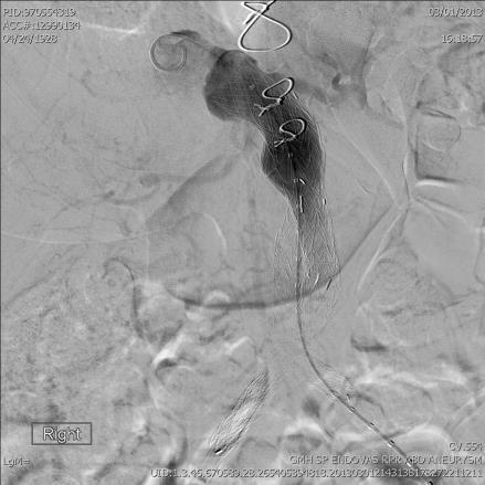 shock 12-16 Fr sheath in aorta Inflate balloon