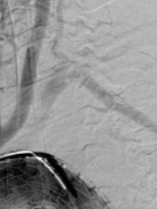 Completion angiogram revealed adequate filling of the left subvclavian through retrograde