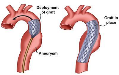 Definitions TEVAR Thoracic Endovascular Aortic Repair Deploying an impermeable graft on a metal scaffold