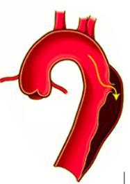layer of the arterial wall (intima) allowing blood flow