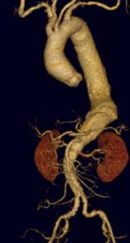 no involvement at renal arteries Despite controlling blood pressure repeat CT