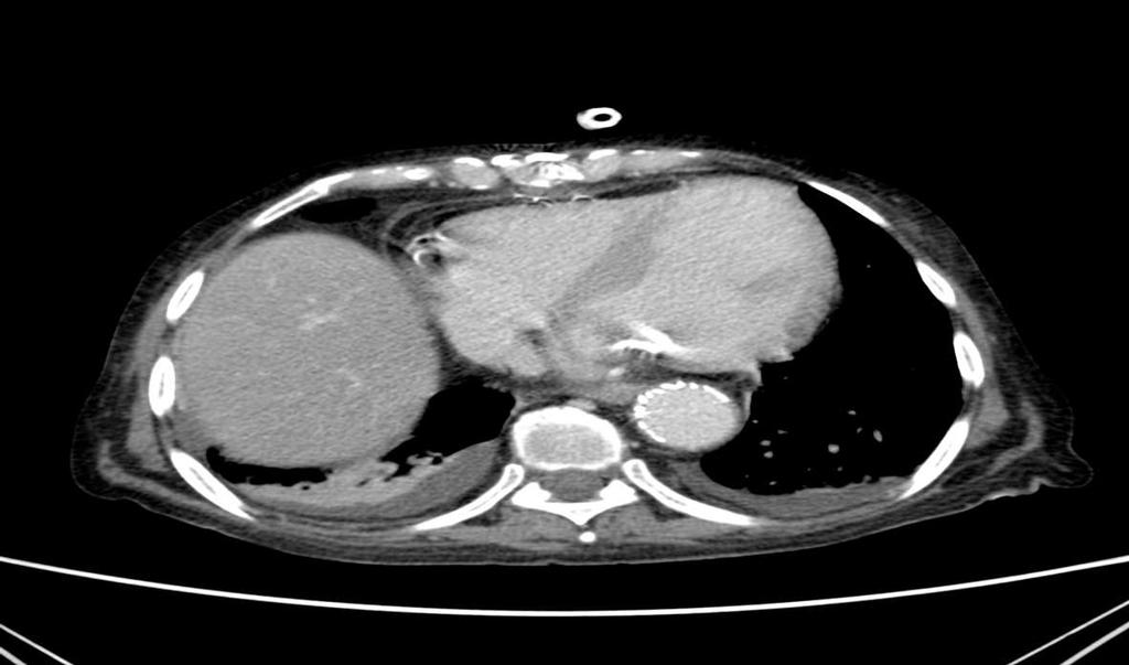 POST-OPERATIVE CTA EVAR for the infra-renal saccular aneurysm was