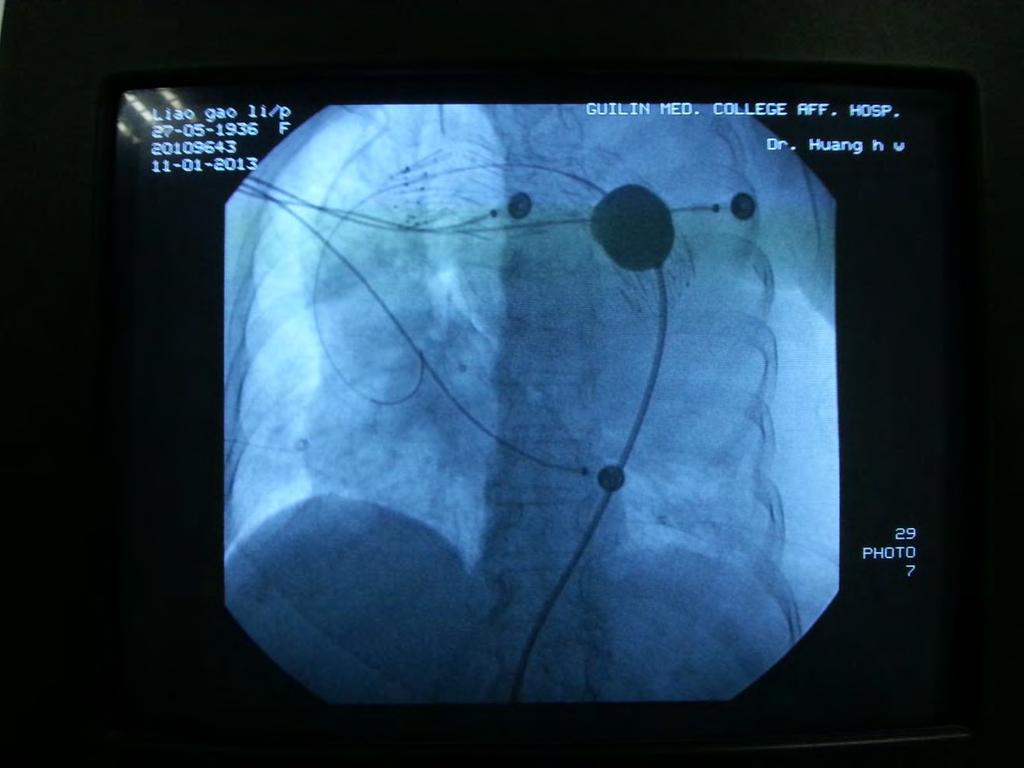 In order to transfer the second stent-graft, we have