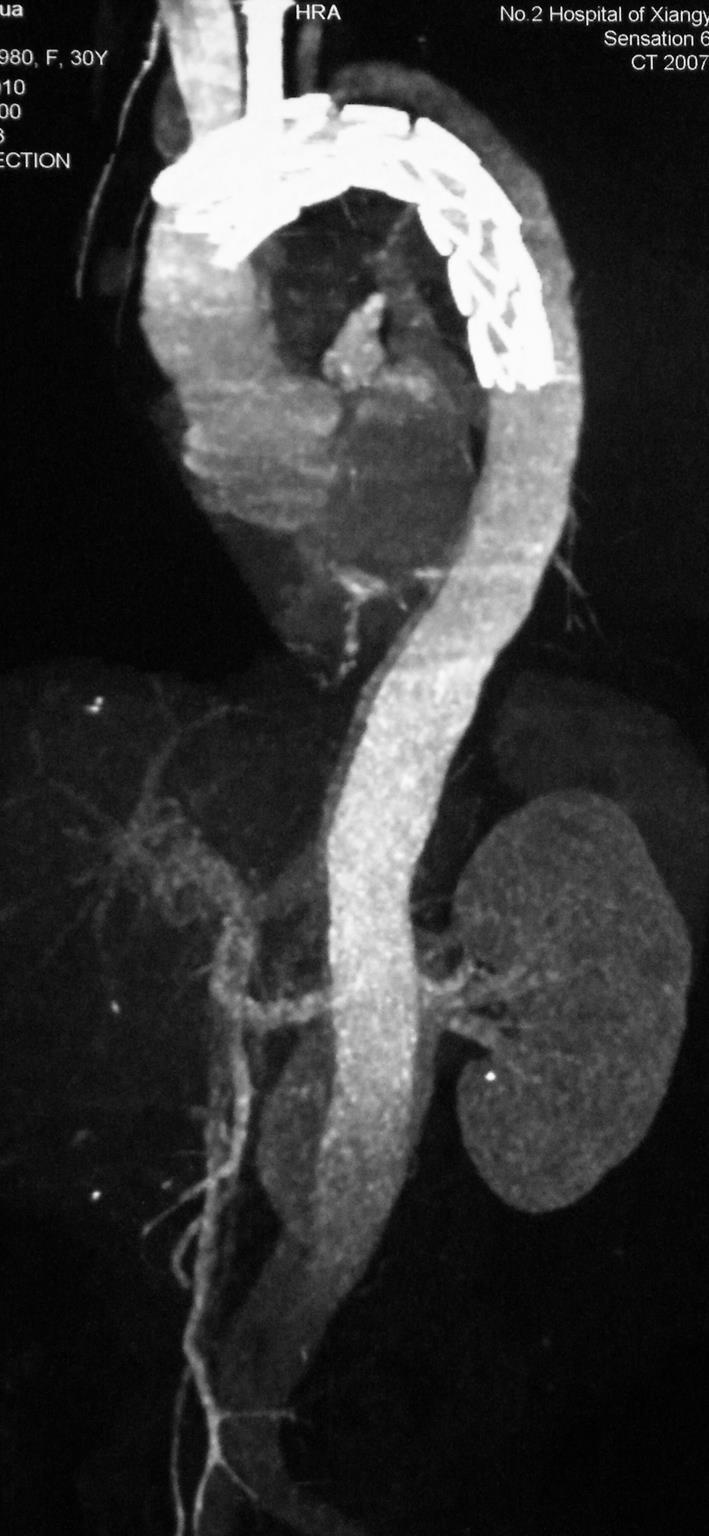 However, CT angiography detected mild contrast in the