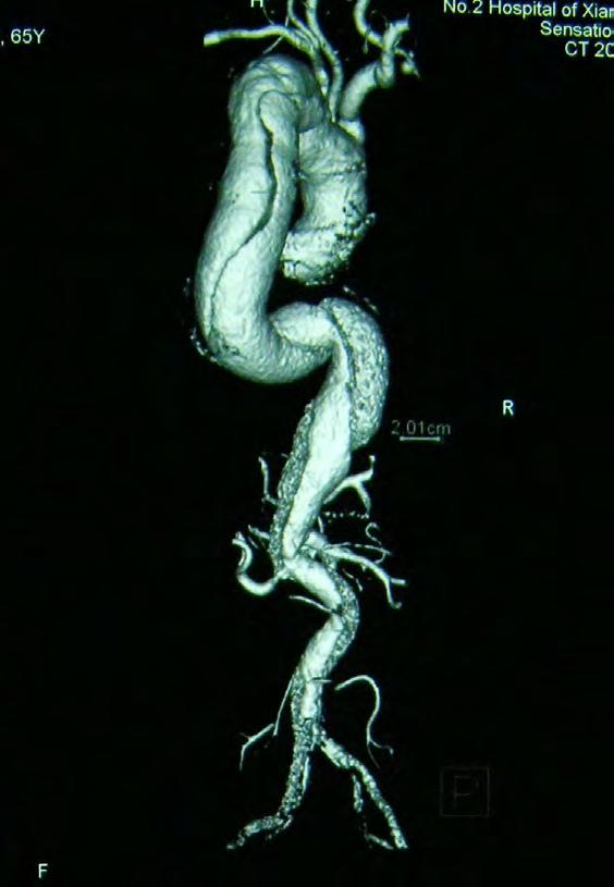 TBAD with renal