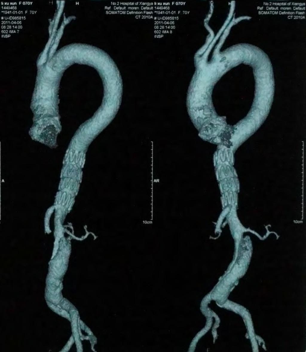 Accurately deployment of the stent-graft was key point. The bottom of the stent-graft was deployed next to SMA.