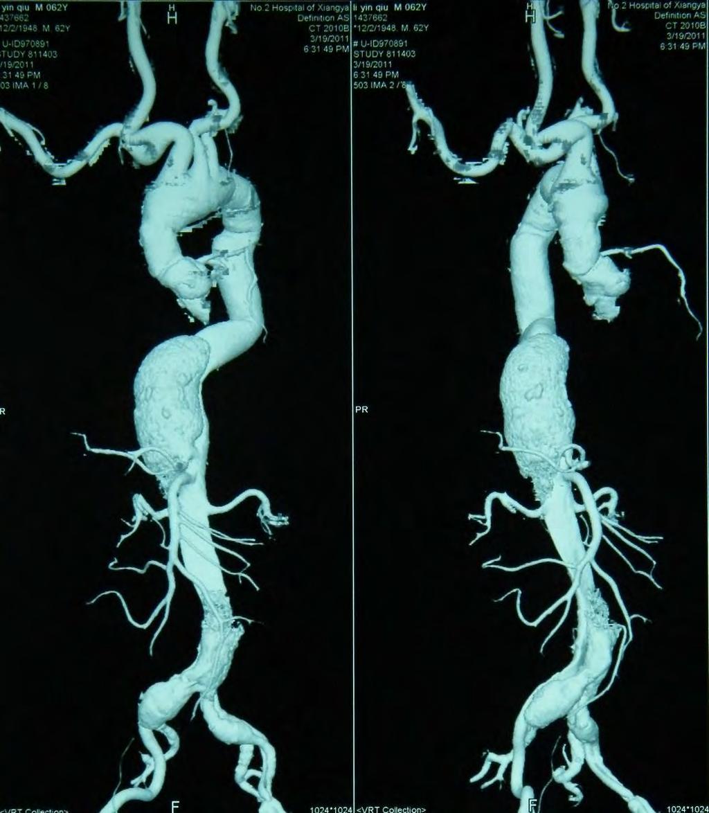 AD involved visceral arteries The patient