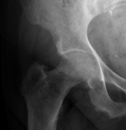 Methods Radiographic assessment of bone changes related to CKD Subligamentous bone resportion ASIS: Sartorius AIIS: Rectus