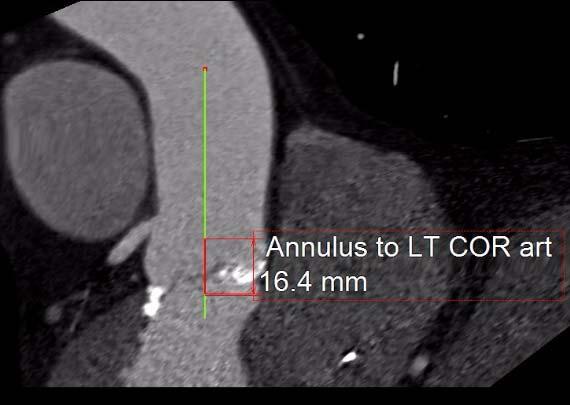 Annular and LVOT