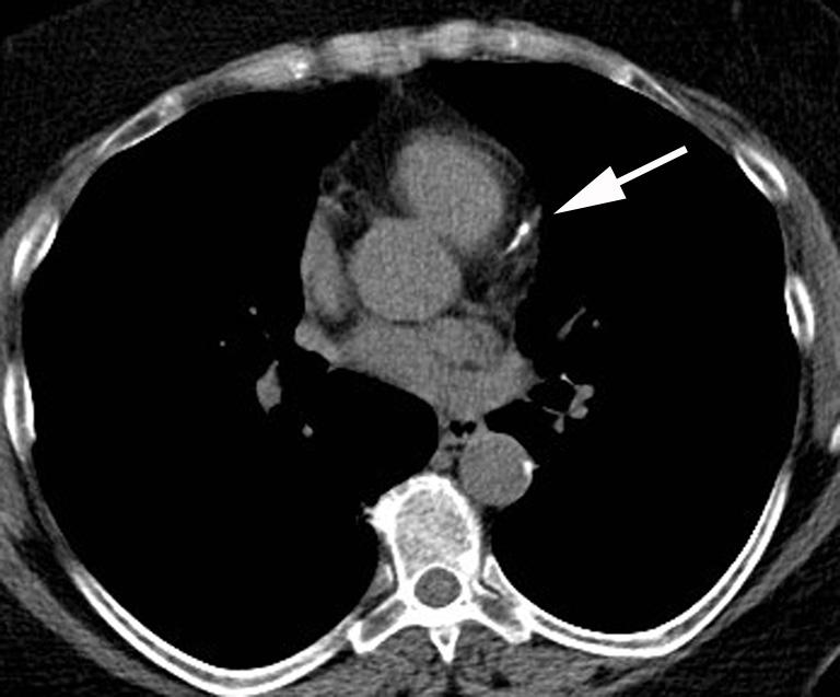 Figure 2 Non-gated CT images from lung cancer screening exam with mild calcium and singular linear calcification in the LAD (arrow). LAD, left anterior descending.