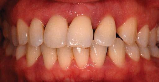 Diagnosis A diagnosis of generalized aggressive periodontitis and pathological tooth migration associated with UL1 and UL2 was established.