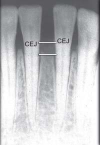B: Interdental bone in (A)