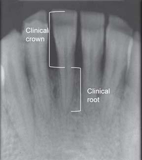 placed on the periodontium. The type of leverage is dependent on the amount of tooth that is within bone (clinical root) in relation to the amount of tooth not within bone (clinical crown).