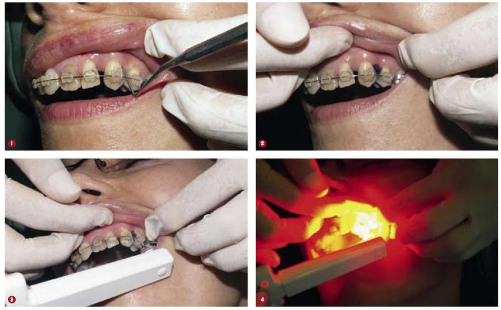 Fig. 1. Periodontal examination of a patient. Fig. 2. Condition after administration of photosensitizer (0,1 mg/ml solution of toluidine blue) into periodontal pocket. Fig. 3.
