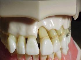Bone loss The bony crest is usually 1 to 2 mm apical to the cementoenamel junction (CEJ) Clinical crown to-root (C:R) ratios are determined according to the amount of root remaining in bone compared