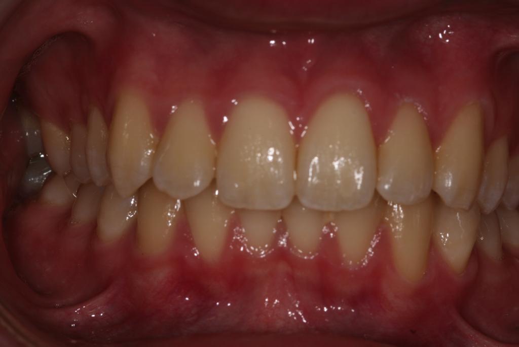 painless Gingival Inflammation Colour