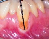 malpositioned tooth 43. The inserted probe was visible through the very thin gingiva.