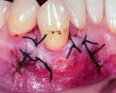 b2 Gingival grafting was performed as a preliminary measure to ensure that a wide band of keratinized gingiva was available for predictable