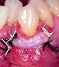 In order to prevent a loss of height of the interdental papillae, only their epithelium was removed.