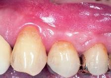 0 mm 1.0 mm Clinical attachment level 4.5 mm 1.0 mm 1.0 mm Width of keratinized gingiva 1.0 mm 2.5 mm 2.