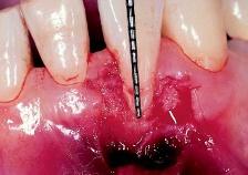 h Twelve years and one month after surgery (03/2006): There was partial loss of the distal interdental papilla, but