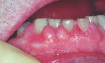 Figure 2: Gingival swelling caused by nifedipine. Figure 3: Oral squamous cell carcinoma. Figure 4: OFG (orofacial granulomatosis).