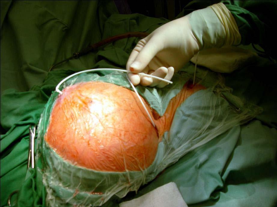Central (ventricular) catheter malfunction