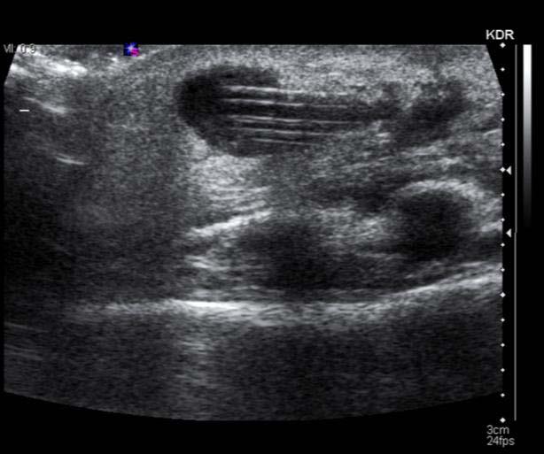 Ultrasound Septic: