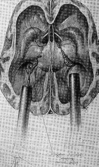 Neuroendoscopy 1923 Mixter first 3rd ventriculostomy 80.
