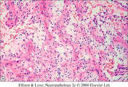 astrocytes (piloid) biphasic pattern