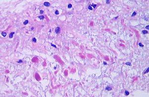 Circumscribed Astrocytoma Rosenthal fibers are common
