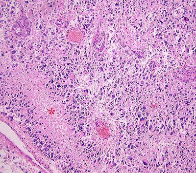 Astrocytic tumors show a histologic continuum from