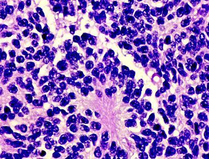 Medulloblastoma Rosette formation is a classic
