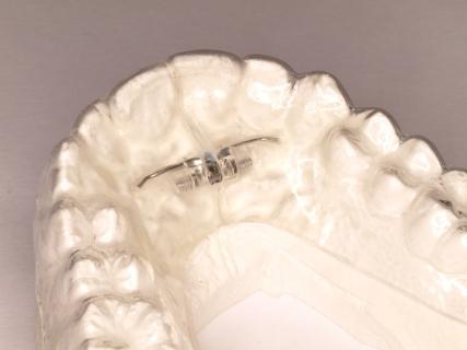 5. TREATMENT PROTOCOL WITH EXPANSION SCREW If a CA CLEAR ALIGNER with a screw is used, only CA CLEAR ALIGNER Hard is received.