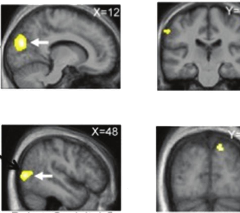 1 5 15 1 5 Sighted Sighted (a) FMRI Intensity Location (b) TMS study Blind Blind Error rate (%) 15 1 5.3.2.1.1 Sighted Sham rtms Real rtms Pitch Blind Location real rtms-sham TMS 3 2 1 1 2 3 Sighted