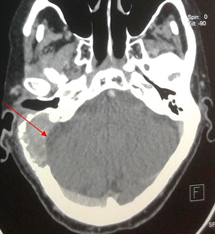 Srp Arh Celok Lek 2018 Online First March 20, 2018 3 The aim of this work was to present an unusual case of facial nerve paralysis as initial sign of temporal bone metastasis of breast carcinoma and