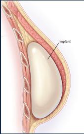 Implant-based reconstruction Autologous reconstruction Total 93,083 Tissue expander and implant 64,391 Implant alone 9,804