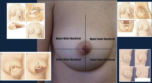 Onco-Plastic Breast Surgery Breast Cancer Safety and Patient