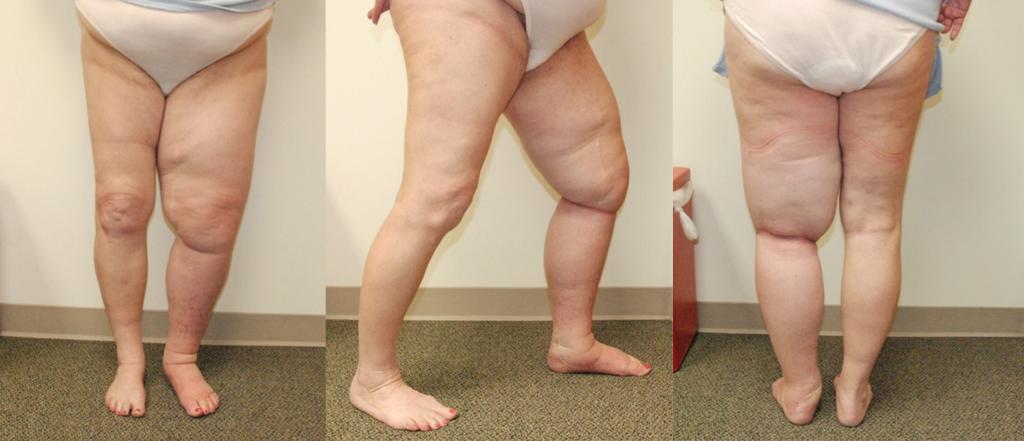 37 Figure 1. Patient suffered from longstanding congenital lymphedema of the left leg prior to the SAPL procedure.