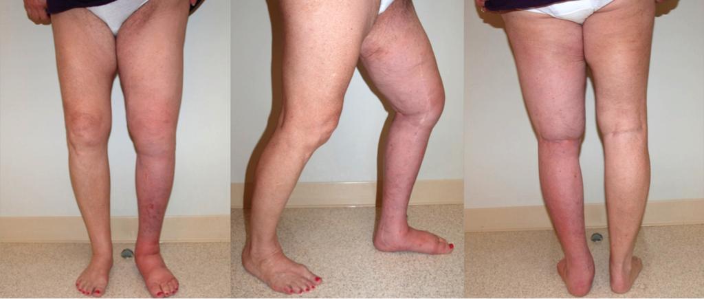 39 Figure 3. Patient at nine months following SAPL. Figure 4. Patient at twenty-one months following SAPL. the affected leg were comparable to those of the unaffected leg (Fig. 3).