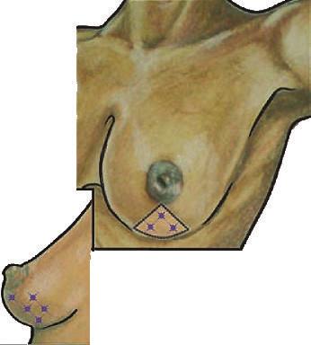 12 International Journal of Breast Cancer (a) Triangle incision (b) Possible tumor locations (c) Resection cavity and specimen (d) Closed triangle incision after extension of IMF incisions Figure 10:
