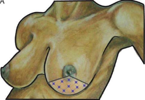 14 International Journal of Breast Cancer (a) Reduction mammaplasty lesion location Wise pattern (b) Reduction mammaplasty resected area (c) Wound closure (d) Closed reduction mammaplasty incision