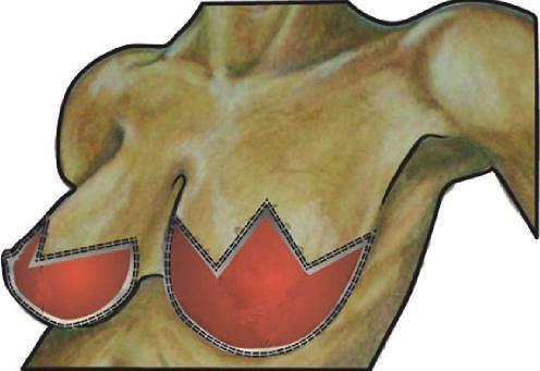 (b) Shows surgical cavity after resection of nipple-areolar complex and inferior breast using Wise pattern. A symmetrical reduction is shown in the opposite breast.