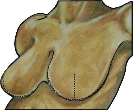 The Wise pattern creates the classic inverted T- or anchor-shaped incision upon closure of the wound and is usually incorporated with an inferiorly based dermoglandular pedicle.