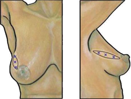 (d) Closed radial ellipse incision Figure 2: Radial ellipse segmentectomy.