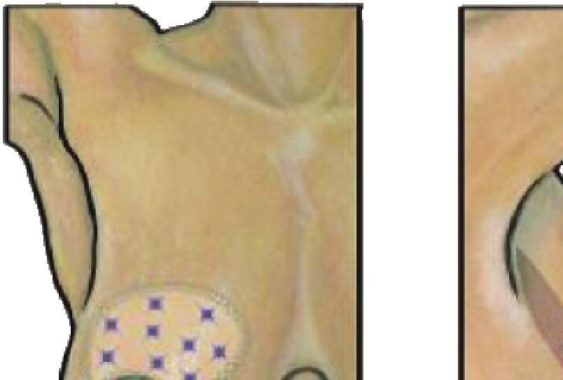 skin Skin undermining medially (a) Circumareolar skin incision (b)