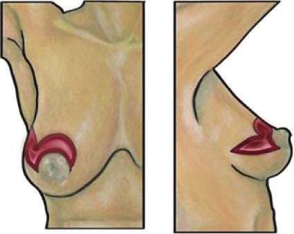 8 International Journal of Breast Cancer (a) Hemibatwing incision (b) Resectioncavity andspecimen (c) Closed hemibatwing incision Figure 6: Hemibatwing resection.