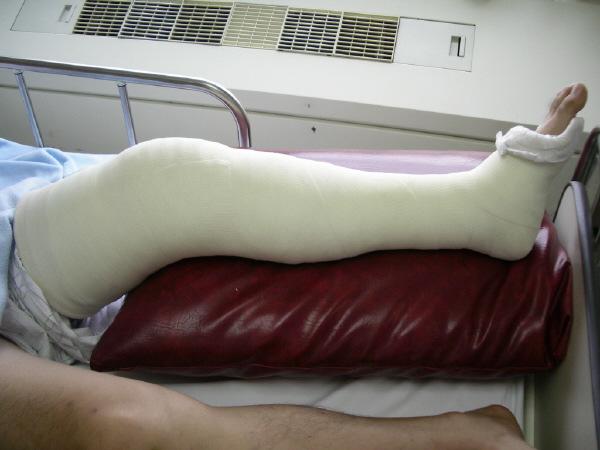 May bear weight in 20 minutes Casts Cast Care Handle with care while