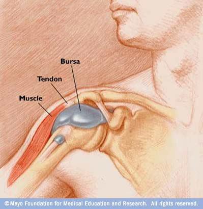 Bursitis Inflammatory condition of the bursa Bursa - fluid-filled sac located adjacent to tendons near large joints Functions: gliding surface to reduce friction between tissues of the body Bursitis