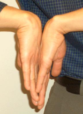 The median nerve in the wrist becomes compressed causing pain and numbness Repetitive injury - Most common